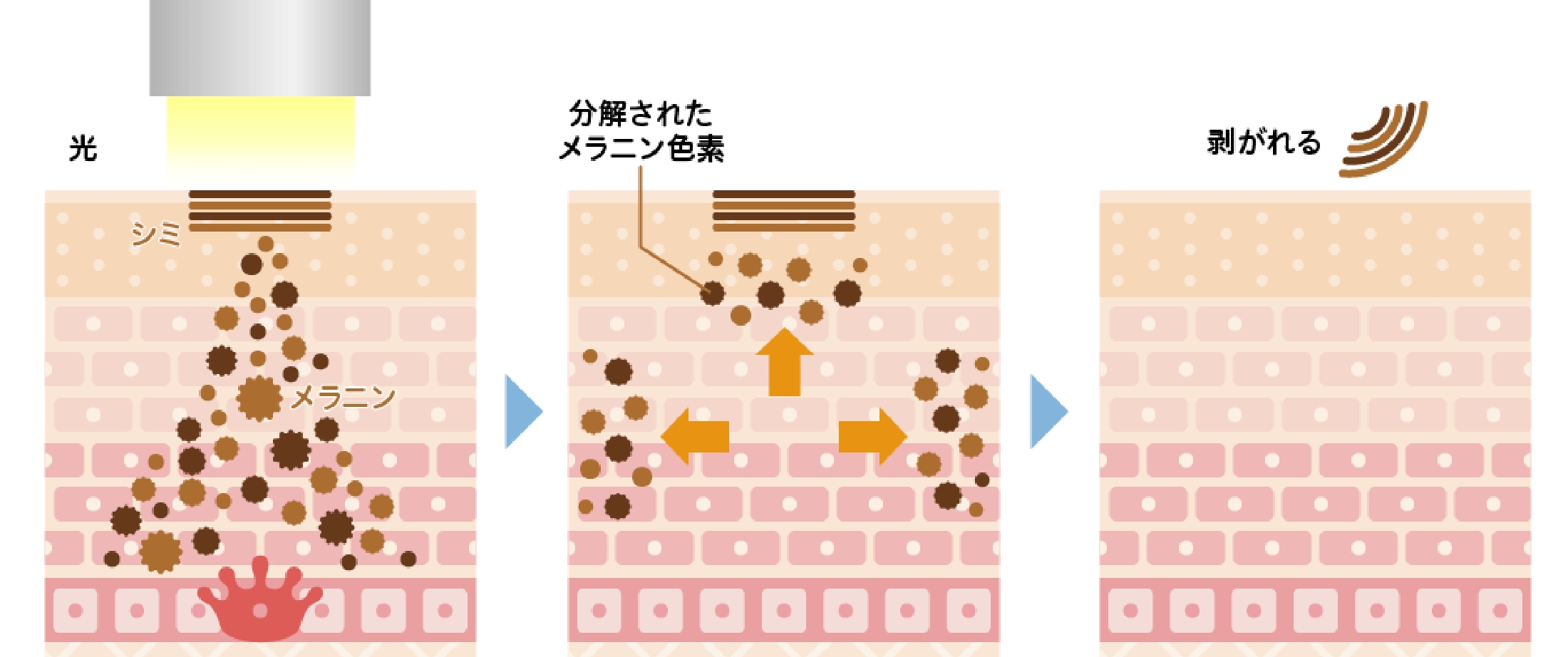 千葉県流山市南流山でIPL光治療（ノーリス）でシミ治療を提供している南流山内視鏡おなかクリニックのシミ治療イメージ図