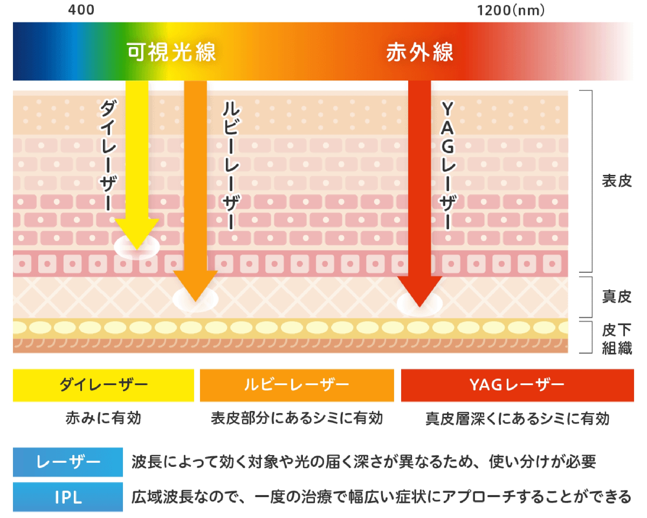千葉県流山市南流山でIPL光治療（ノーリス）でシミ治療を提供している南流山内視鏡おなかクリニックのシミ治療イメージ図