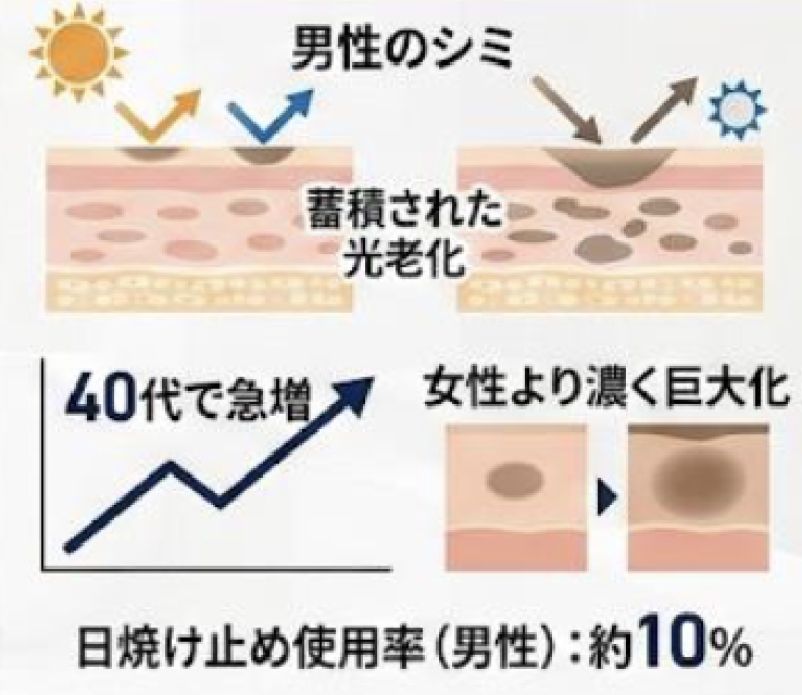 千葉県流山市南流山でIPL光治療（ノーリス）でメンズシミ治療を提供している南流山内視鏡おなかクリニックのメンズシミ治療イメージ図