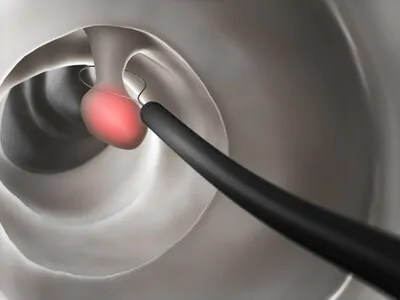 日帰りで行う大腸ポリープ切除