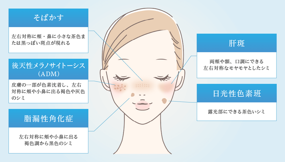 南流山内視鏡おなかクリニックのシミの種類解説