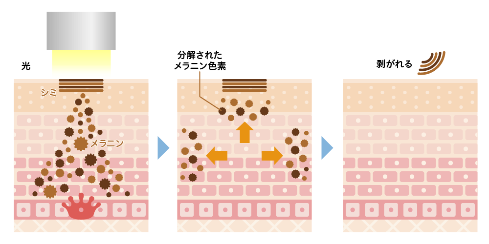 流山市の南流山内視鏡おなかクリニックノーリス（IPL光治療）がシミに効く仕組み